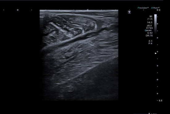 Quand une lésion en cache une autre...