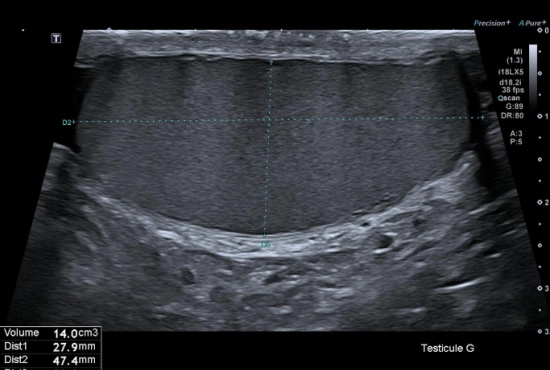 "Quand une douleur testiculaire cache une hernie inguinale : l'importance de l'exploration systématique des orifices herniaires"