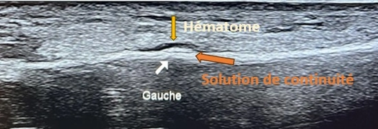 Une fracture de fatigue