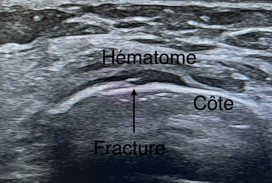 Fracture de côte
