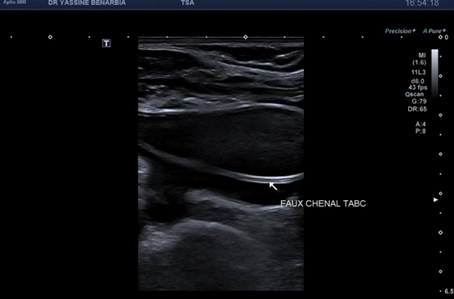 Dissection aortique de type III