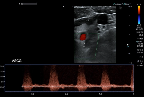 De l’importance du transcrânien
